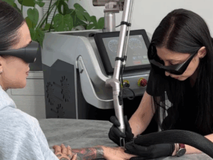 usuwanie tatuażu Łódź – zabieg w studio FADE AWAY