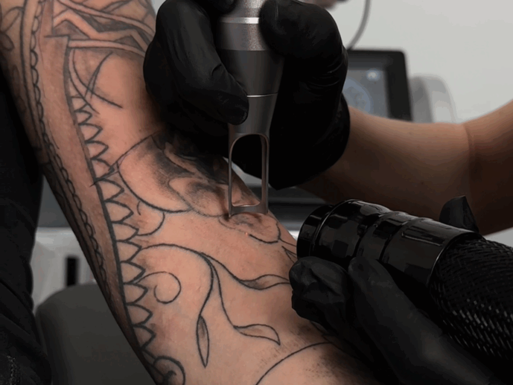 usuwanie tatuażu Łódź – zabieg w studio FADE AWAY
