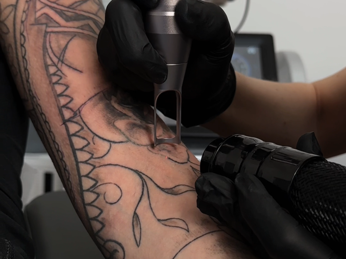 usuwanie tatuażu Łódź – zabieg w studio FADE AWAY