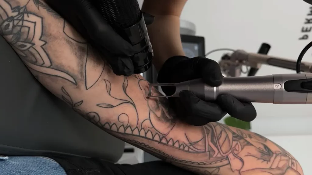 usuwanie tatuażu Łódź – zabieg w studio FADE AWAY