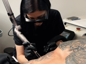 zabieg usuwania tatuażu laserem w studio w Łodzi