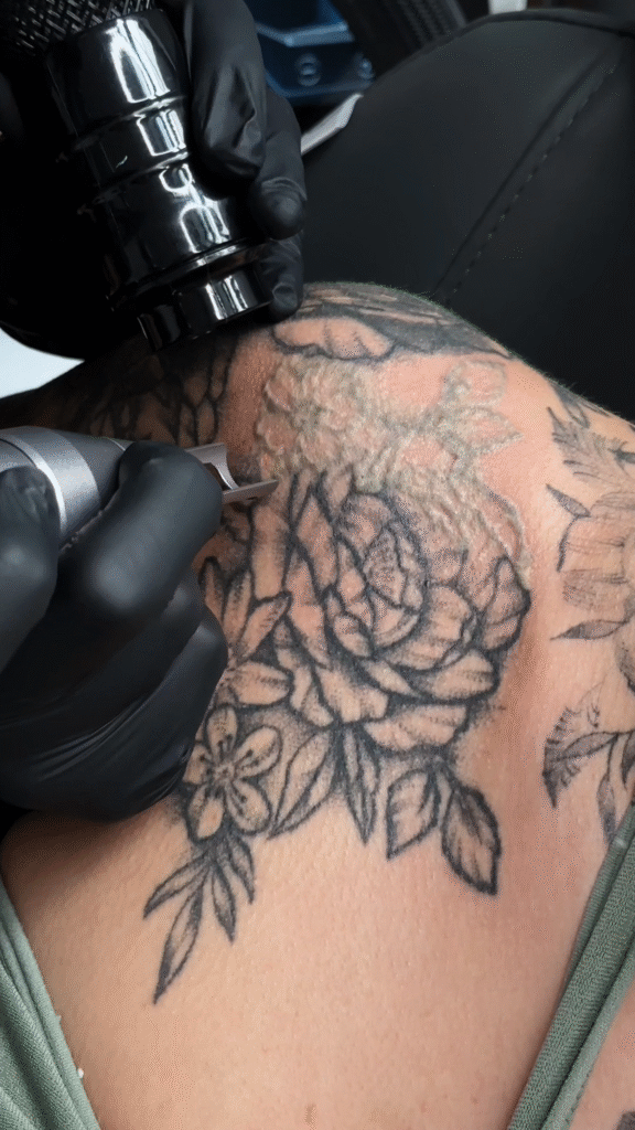 zabieg usuwania tatuażu laserem w studio w Łodzi