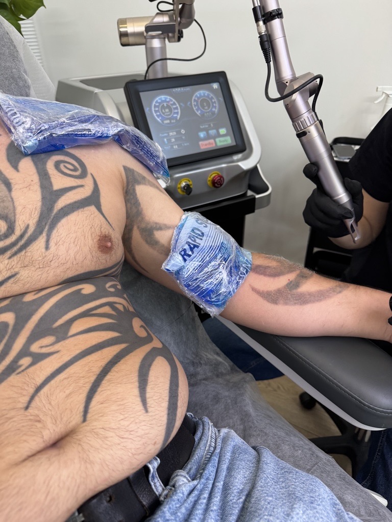 Laserowe usuwanie tatuażu Tribal